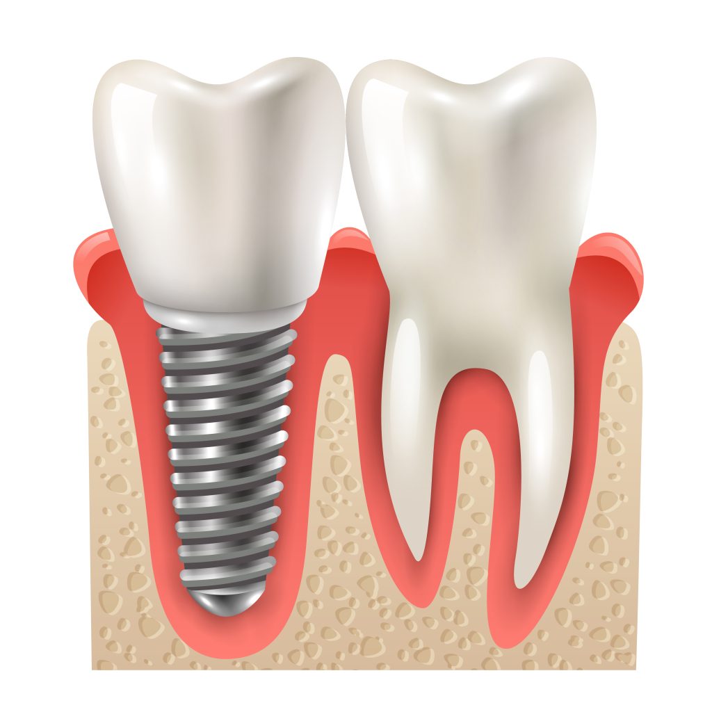 dental implant tooth set closeup model